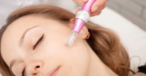 microneedling