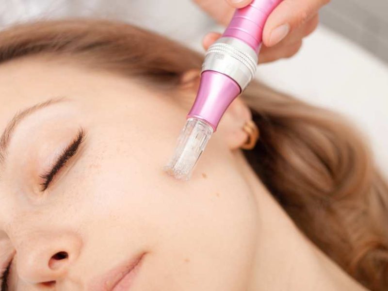 microneedling