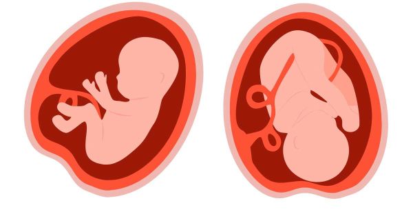 baby in different womb positions