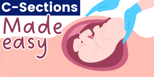 image of a c-section/  c-sections made easy