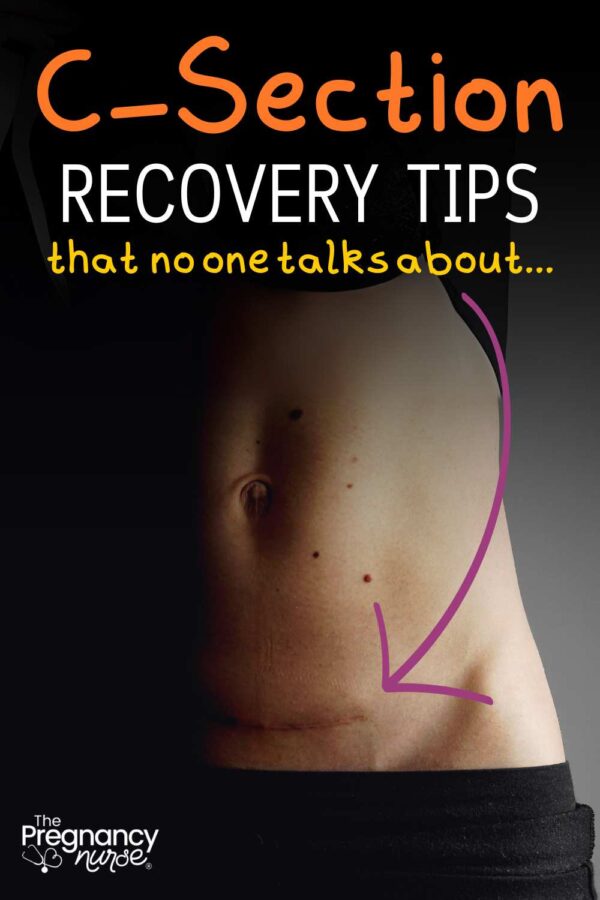 image of a cesarean scar // c-section recovery tips that no one talksa bout